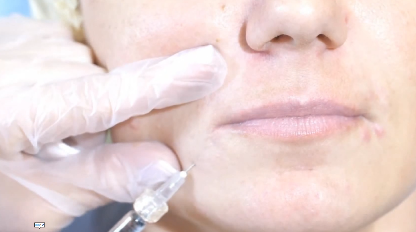 Кој се е инволвиран во илегалниот увоз на ботокси и филери?