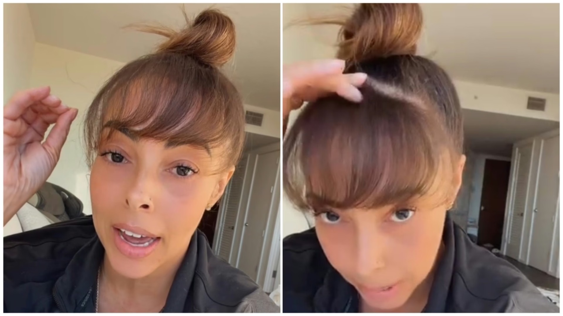 Отишла на трансплантација на коса и открила несакан ефект што го збунил дури и хирургот: „Ова никогаш порано не се случило“